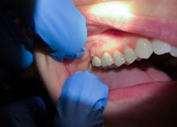 Best Emergency Gum Treatment in St Charles, MN