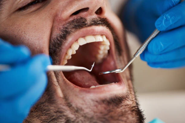 Best Emergency Dental Care for Broken or Chipped Teeth in St Charles, MN